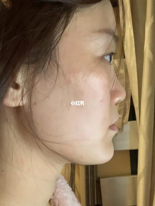 没有苹果肌08 鼻基底凹陷_苹果肌_玻尿酸_侧脸_美妆