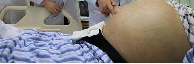 肝硬化肝腹水没救了吗?医生:对症治疗能治好,别灰心