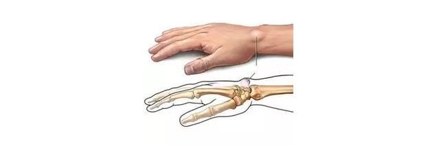 腱鞘炎这样治疗是医生小题大做