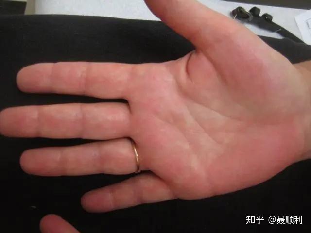 红斑狼疮的不常见皮肤改变(下)
