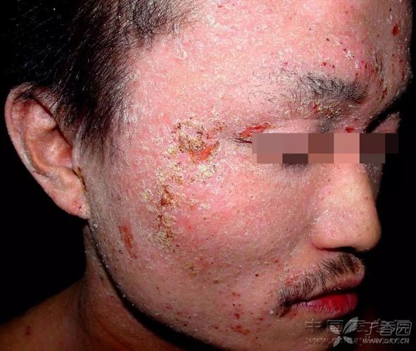 面部异位性皮炎