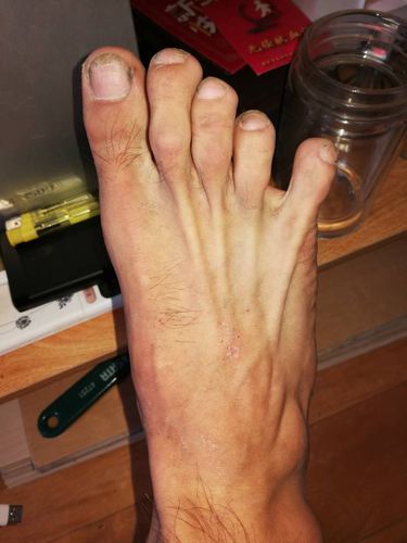 这个脚底是人字纹吗