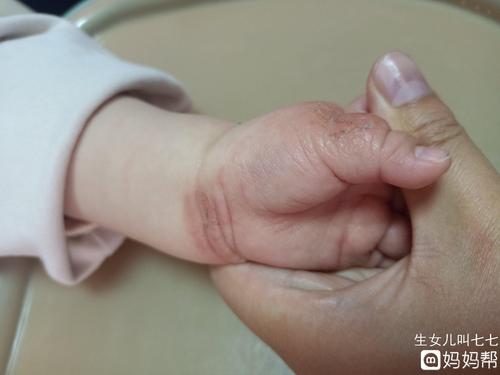 宝妈们宝宝手上湿疹你们遇到过吗每次