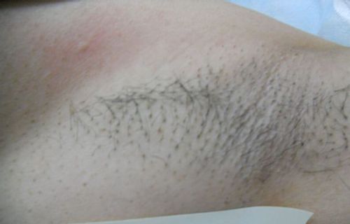 脱毛后肌肤出现各种问题~哭