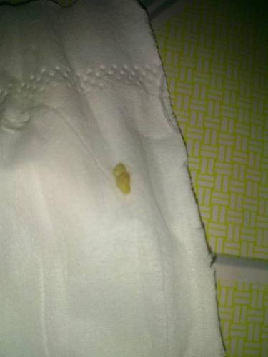 有时候咳嗽能咳出痰.今天咳嗽就咳出个这个东西.看图. 像牙齿一样的