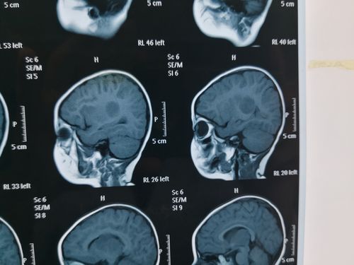 朱育霆 2岁 左侧脑室及丘脑占位 13903809976(副本)