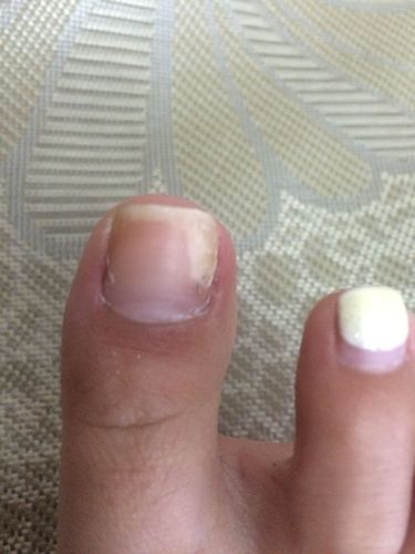 这样的脚指甲是缺钙还是灰指甲?