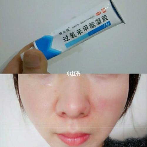 一只用了会烂脸的药膏-过氧苯甲酰凝胶 本人属于黑头相当严重的_凝胶