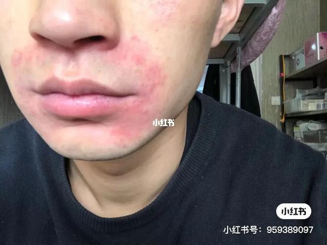 口周皮炎_皮炎_皮肤管理_脂溢性皮炎_口周皮炎_医疗健康_医疗健康其他