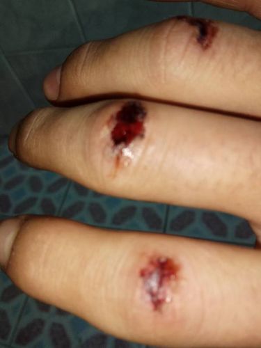 拳头出血图片男生