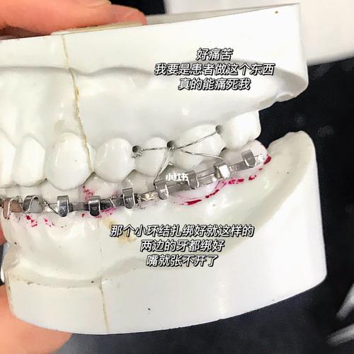 今天做牙弓夹板!