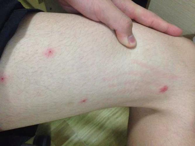 这是被螨虫咬的吗