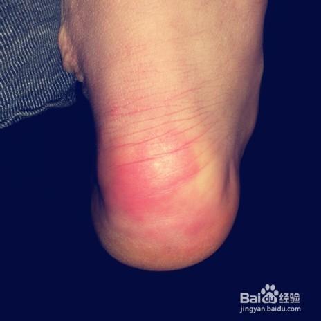 楚楚"冻"人当心长冻疮