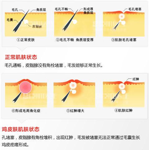 (角栓堵塞毛孔形成鸡皮肤示意图) 由于囊皮脂腺管开口处由于长期的