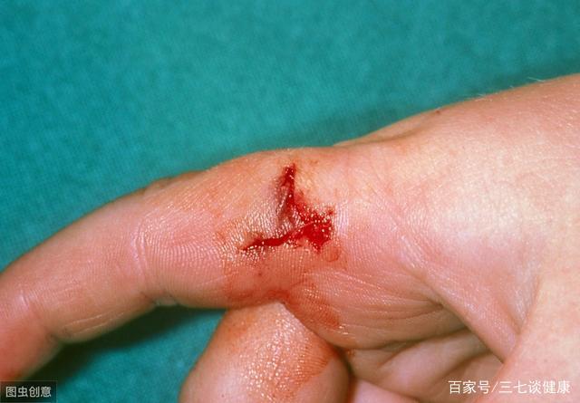 夏季被狗咬伤的高发期,被咬伤后该如何处理伤口,赶快