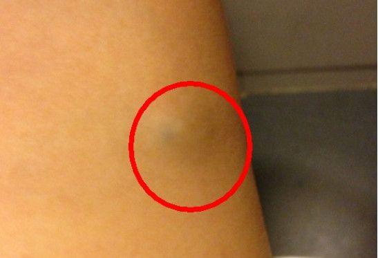 到时压迫到神经就会严重,但是这种脂肪瘤一般都是良性的,虽然很很少