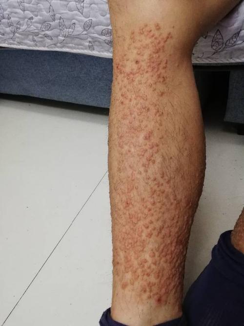 身上腿上都长了很多疮,是怎么回事