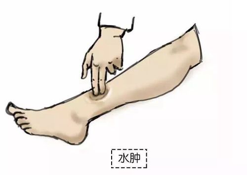 孕期,水肿,下肢,papi酱