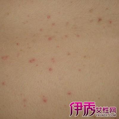 【图】识别疥疮的初症状图片 一般和药物2种疗法结合佳