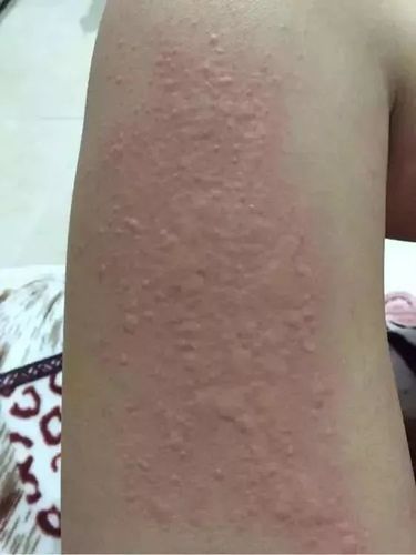 一到冬天身上就起红疙瘩你可能是这个病