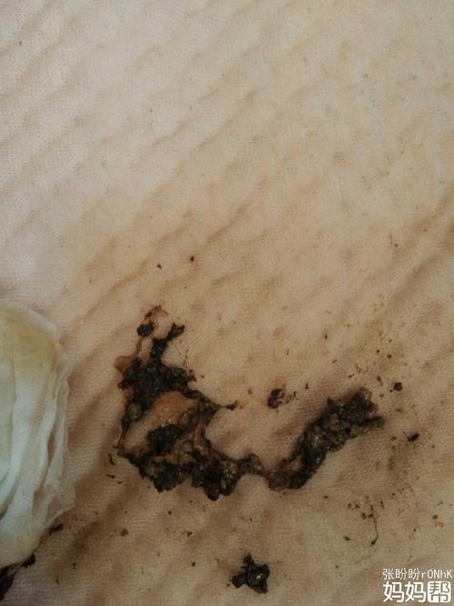 怎么宝宝大便常是奶瓣呀!谁有办法有没有好的建议