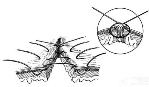 间断垂直褥式内翻缝合