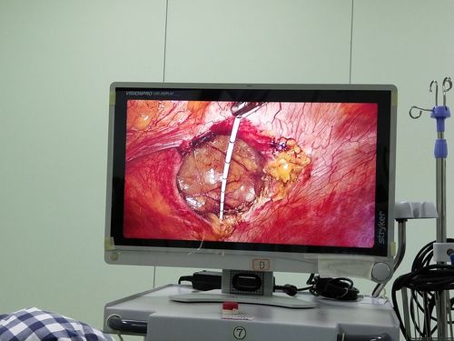 腹腔镜下腹壁切口疝修补术