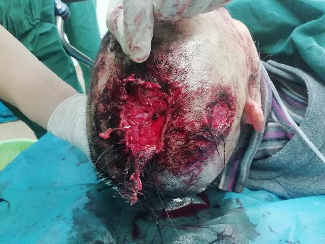 9床车祸伤导致头皮撕裂伤伴局部缺损