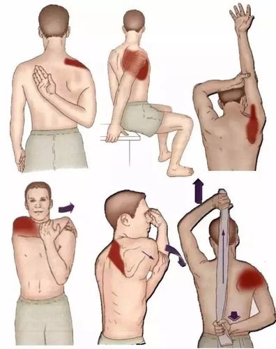 胸椎侧弯锻炼 (第1页)