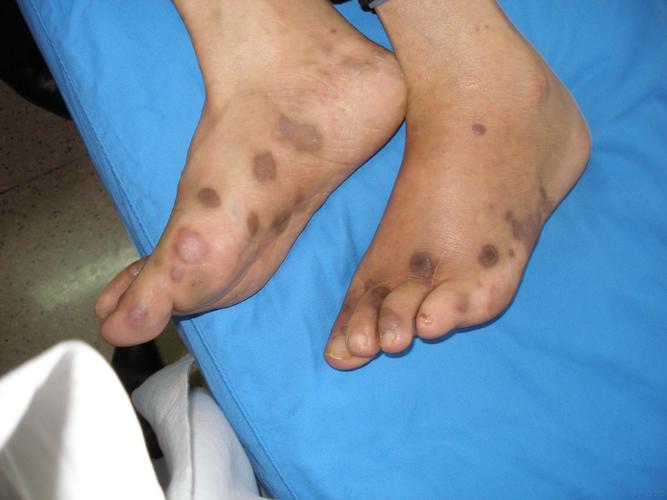 皮肤结核?kaposi肉瘤?