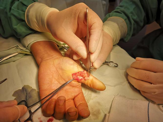 一例拇长屈肌腱封闭后断裂 - 病例中心(诊疗助手)