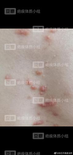 瘢痕疙瘩 好像要治好了