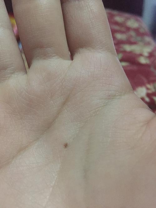 手上的黑点是什么?