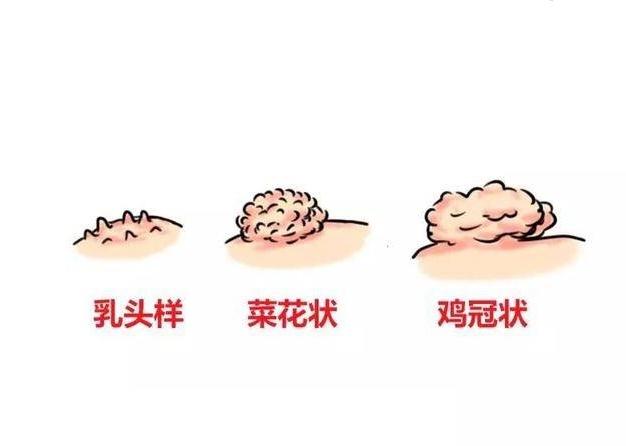 尖锐湿疣会只长一个疣体吗