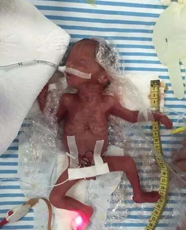 24周早产儿存活出生仅500克 被取名九爷征服网友