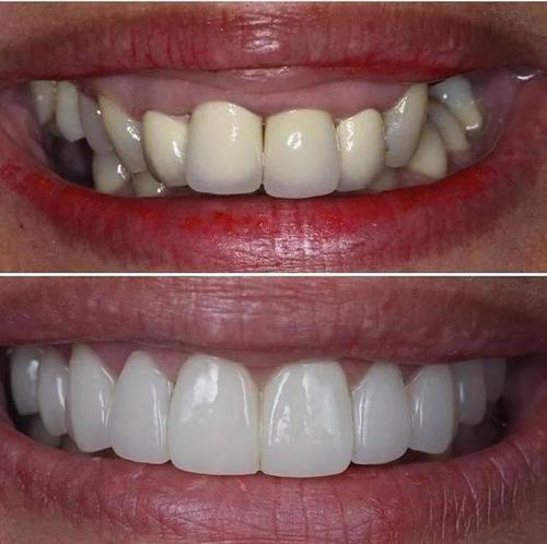 爱牙网:烤瓷牙,全瓷牙,种植牙有什么区别?哪个比较好?