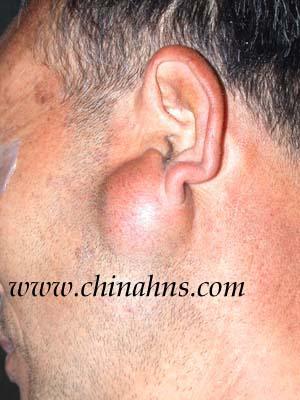 转贴腮腺区表皮样囊肿手术过程