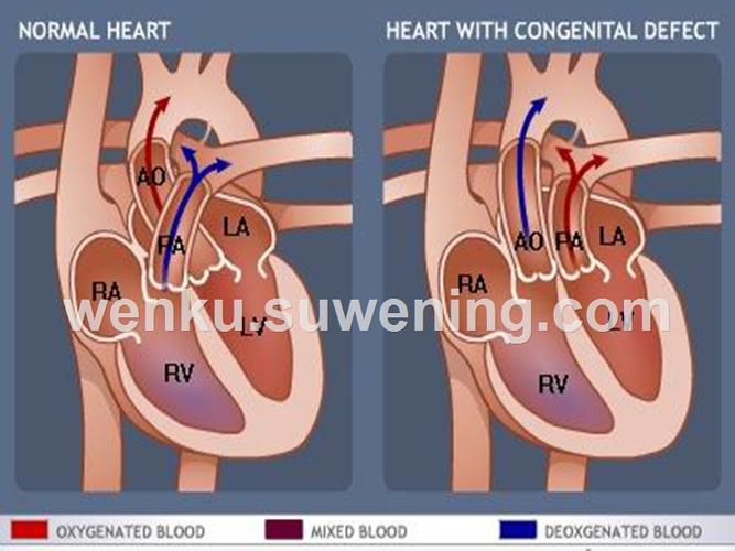 完全性大动脉转位 completetranspositionofgreatarteries 指主动脉和