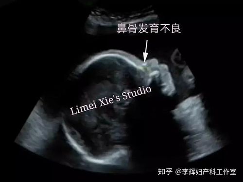 胎儿鼻骨缺失和或发育不良的医生专业指导