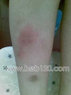 白塞氏病结节性红斑