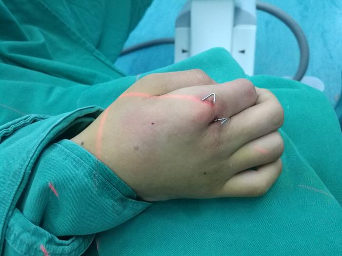 分享3例掌骨骨折闭合复位克氏针内固定术.