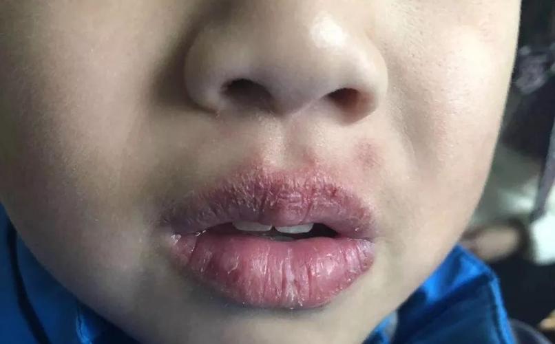 冬天孩子嘴唇干裂,怎么办?用耳穴疗法让孩子不再受罪!