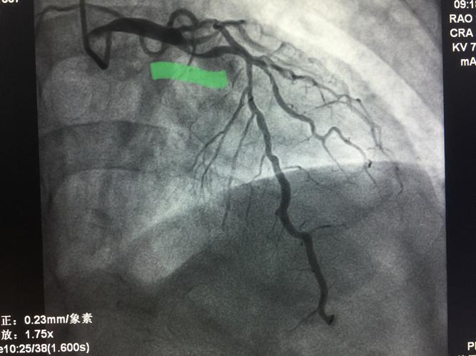 造影提示三支弥漫性病变,acc/aha冠脉病变分型:c型,synta