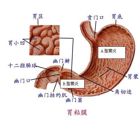 胃窦慢性萎缩性胃炎伴轻度肠化幽门螺杆菌检测