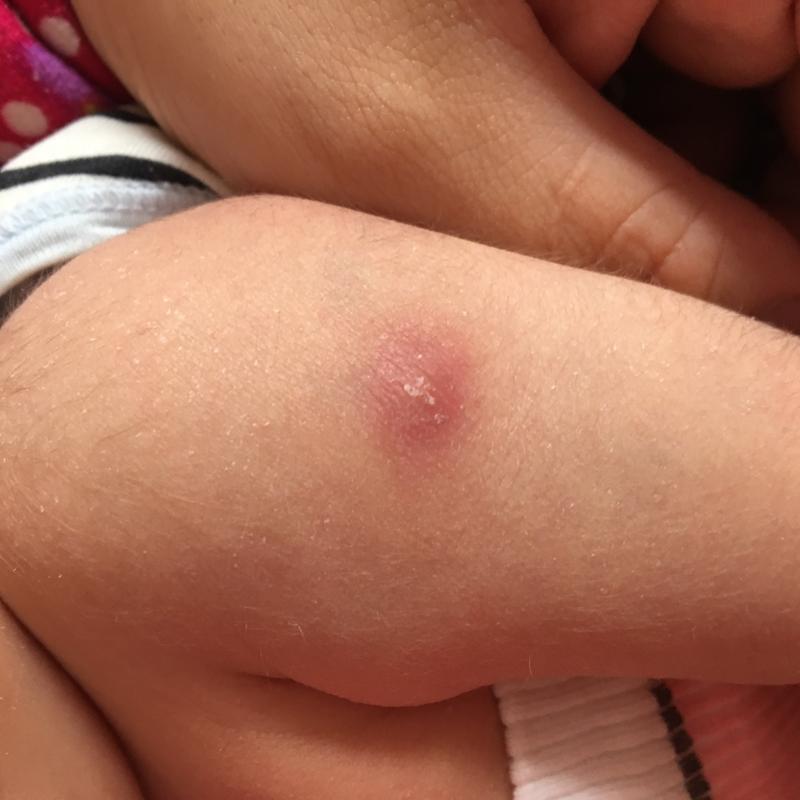 宝宝现在一个月加五天,现在发现宝宝胳膊上出生当天打得那个疫苗