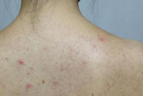 向兰心录后背痘痘疯长已成螨虫窝不必去医院教你3招快速灭螨祛痘