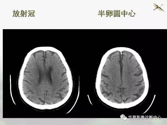 半卵圆中心与放射冠有什么区别?