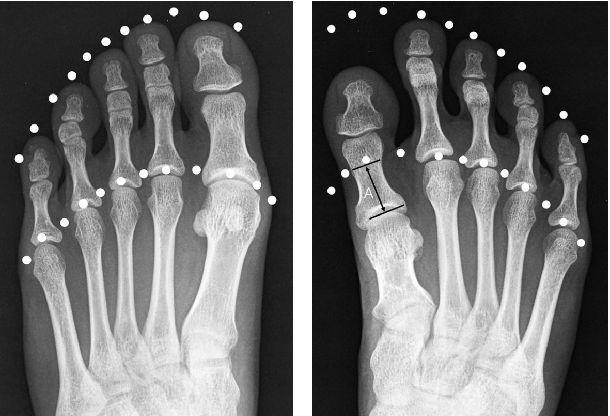 脚趾短小怎么办?