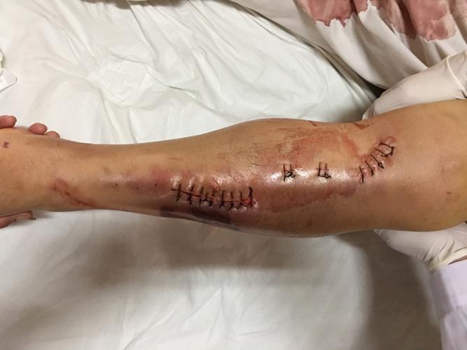 术后伤口缝合完毕