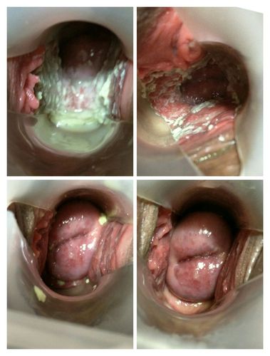 宫颈息肉,宫颈糜烂,宫颈纳囊等妇科疾病,有病早防早治是关键我